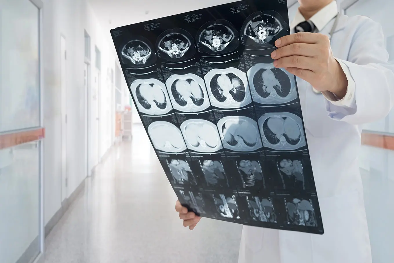 Isenção de imposto de renda por neoplasia maligna